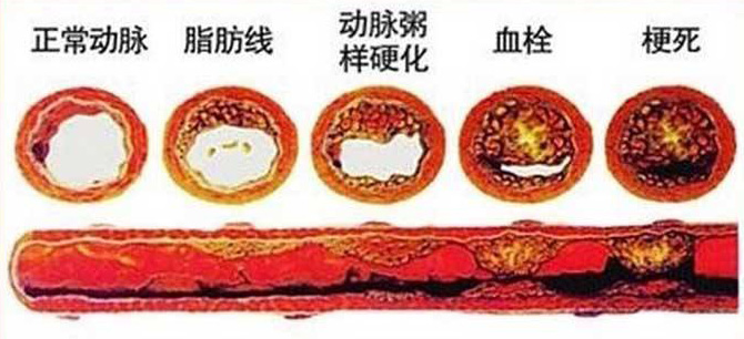 血栓在哪，病就在哪！該怎么清除血栓呢？