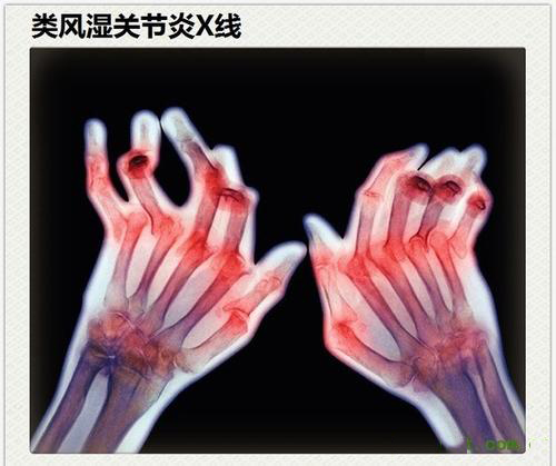 類風濕性關節(jié)炎真的是“不死的癌癥”？