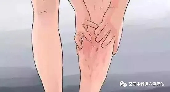治療靜脈曲張，中醫(yī)有良方，一根針讓你告別“蚯蚓”腿